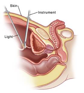 Side view of cross section of child's pelvis showing bladder and urethra. Instruments are inserted in pelvis through skin. One instrument is shining light where another instrument is grasping part of urinary tract.