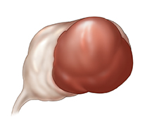 Endometrioma.