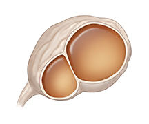Cistoadenoma benigno.