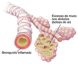 Bronquíolos e sacos alveolares com acúmulo de muco e inflamação por causa da pneumonia.