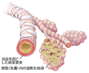 肺炎による粘液の蓄積と炎症を伴う細気管支と肺胞。