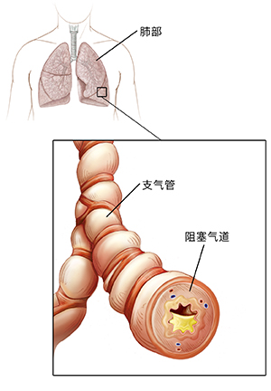 显示气管和肺部的人体胸腔轮廓。显示发炎和积液的支气管特写镜头