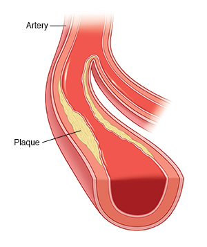 Cross section of peripheral artery with plaque buildup.