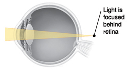 Corte transversal do olho mostrando a luz focando atrás da retina.