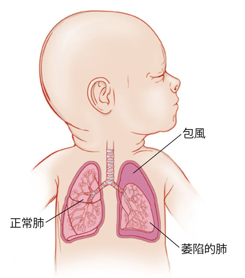 小孩頭轉向一側的略圖,顯示了氣管和肺部。左肺周圍有滯留空氣,肺萎陷。