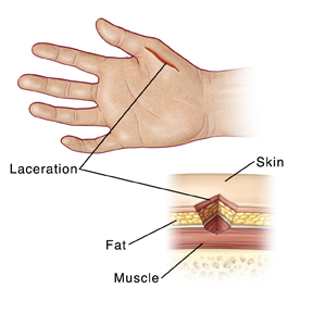 Image of a hand with a laceration and a close-up cross section of the laceration that labels the fat, skin, and muscle.