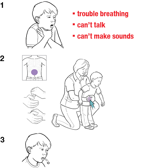 Step-by-Step- Choking Rescue for a Child (Over 1 Year of Age)