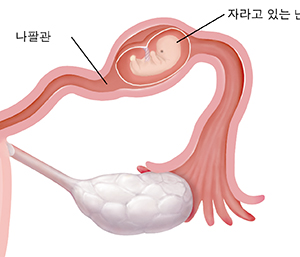 자궁 외 임신으로 배아가 내부에서 자라고 있는 나팔관의 단면 근접 모습.