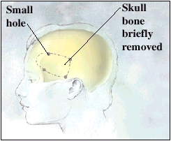 Side view of head with skull inside. Four small holes are in skull at corners of rectangle. Bone inside rectangle is briefly removed.