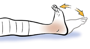 Leg from knee down showing ankle pumps. Bandage on knee.