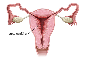 एंडोमेट्रियल हाइपरप्लासिया को दर्शता हुआ महिला प्रजनन मार्ग का सामने के दृश्य का क्रॉस सेक्शन।