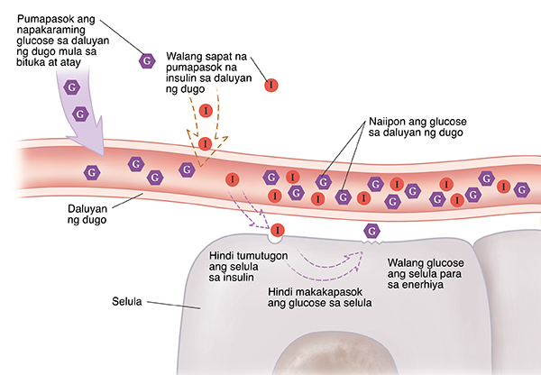 Closeup cross section ng daluyan ng dugo na malapit sa mga selula na ipinapakita ang Type 2 diabetes. Hindi tumutugon ang selula sa insulin. Hindi makapasok ang glucose sa mga selula at natitipon sa daloy ng dugo.