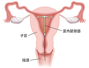 子宮和陰道橫截面,顯示宮內節育器在子宮內的位置。