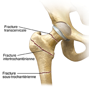 Vue antérieure de l'articulation de la hanche montrant trois types de fractures de la hanche.