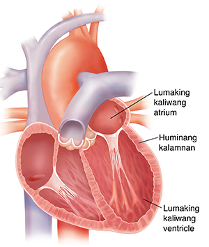 Cross section ng lumaking puso. Manipis ang pinakadingding ng puso.